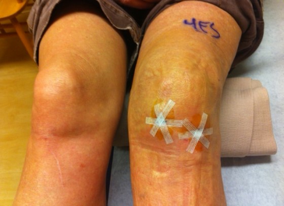 Yet another 2 spectacular scars to add to my collection!